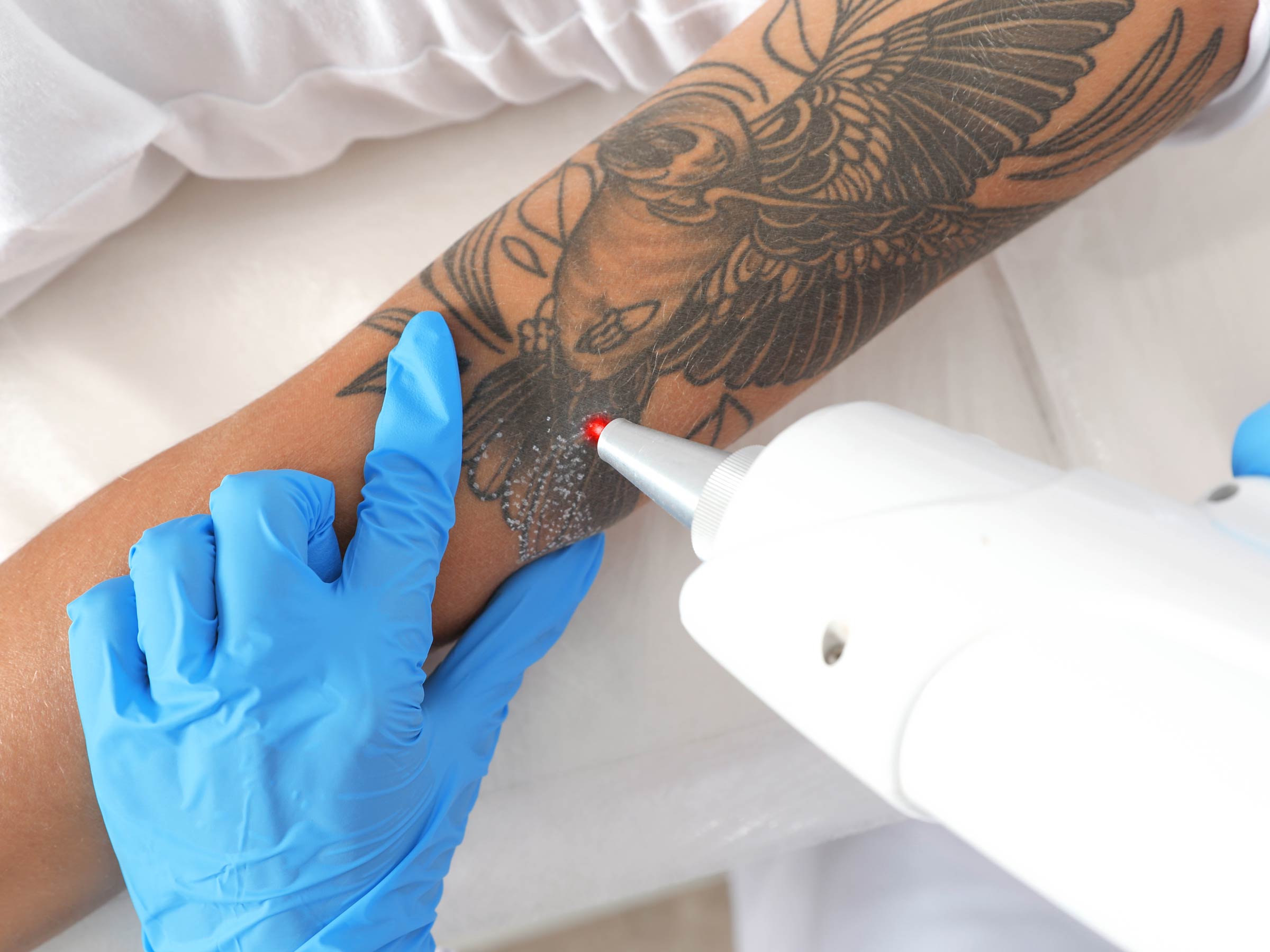как удалить татуировки в домашних